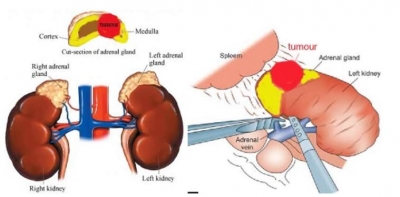 laparoscopic adrenelectomy