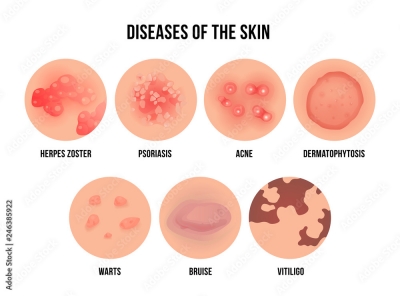 Skin Disease