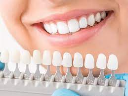 Scaling, Bleaching, Veneers