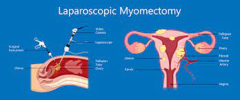 Myomectomy