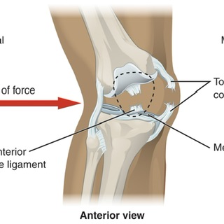 Ligament Injury