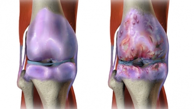 Osteoarthritis of knee joint,