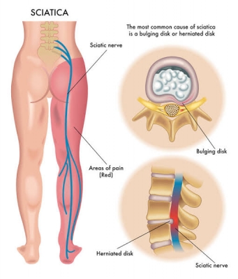 Sciatica / Nerve Compression