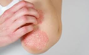 Psoriasis