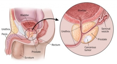 Prostate