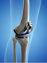 Knee Replacement Physiotherapy