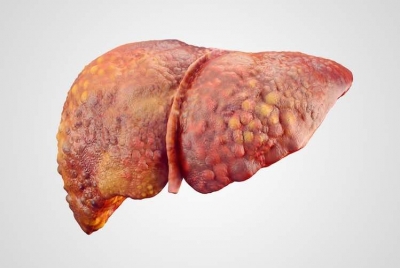 Liver Disease