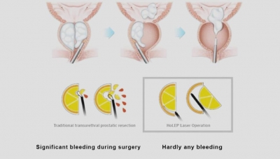 holmium laser enucleation of prostate( HOLEP)