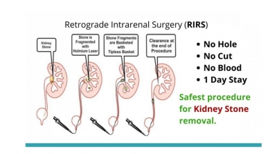 retrograde intrarenal surgery RIRS