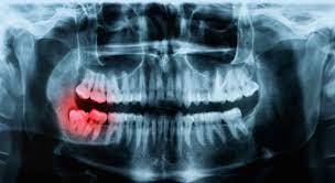 Teeth X-ray