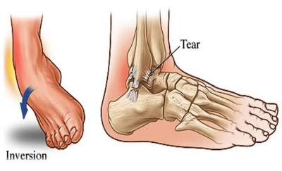 Ankle sprain