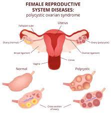 Ovarian Diseases