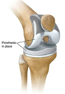 Knee Replacement Physiotherapy