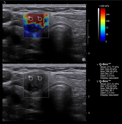 ELASTOGRAPHY