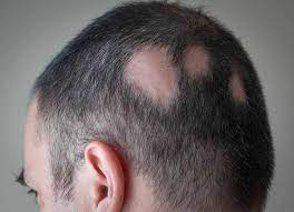 Alopecia Areata